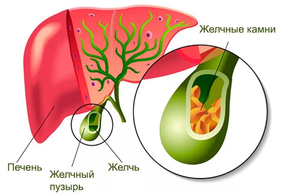 Желчнокаменная болезнь картинки для презентации