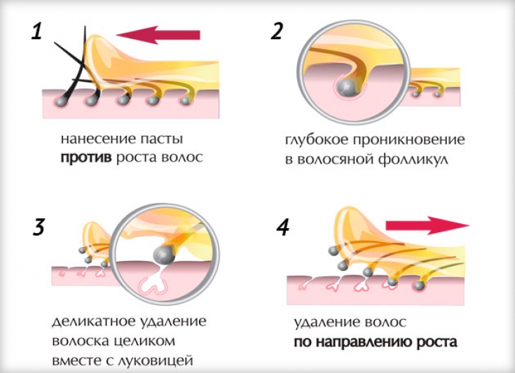 Как эффективно и безопасно выполнить шугаринг бикини